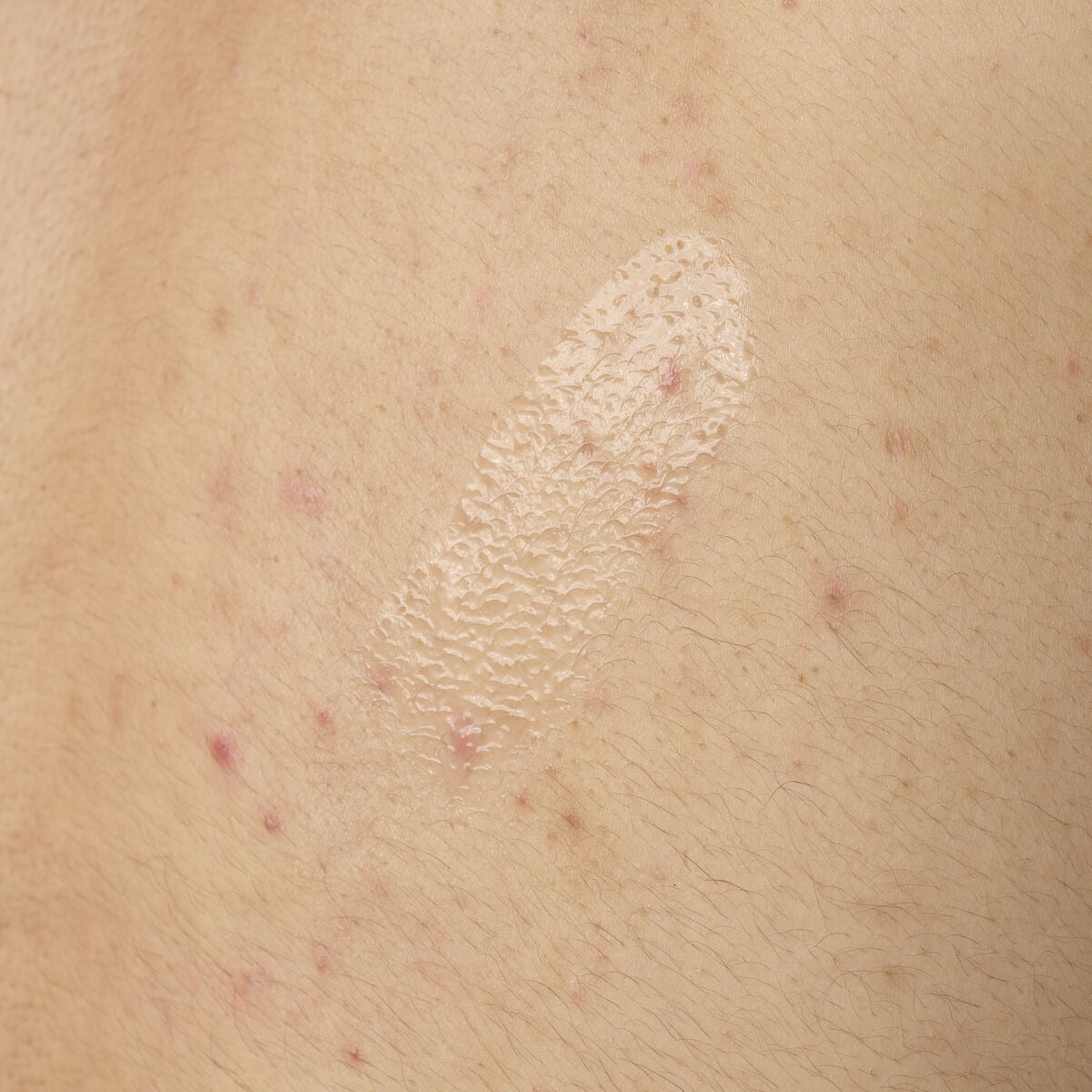 salicylic-acid-0-5-body-serum-r5 ORD-salicylic-acid-05-body-240ml-application.jpg