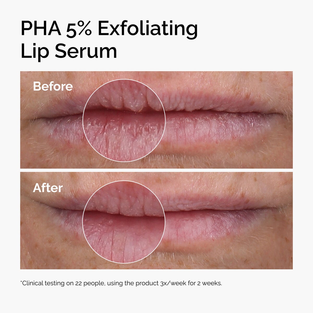 pha-5-exfoliating-lip-serum-m9 ord-pha-5pct-lip-exfoliating-serum-before-after.jpg
