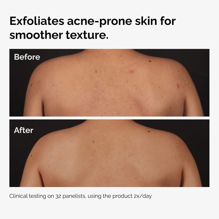 the-body-care-collection-o6 ord-salicylic-acid-body-serum-before-after-graphic-NA.jpg