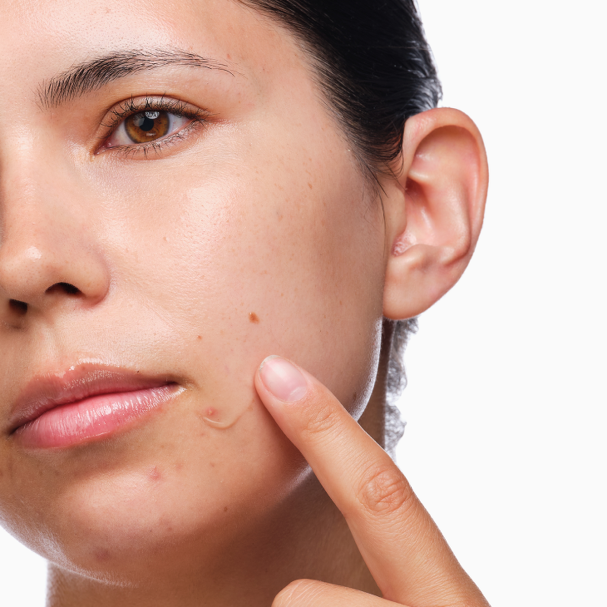 the-acne-set-k2 rdn-the-acne-set-application.png